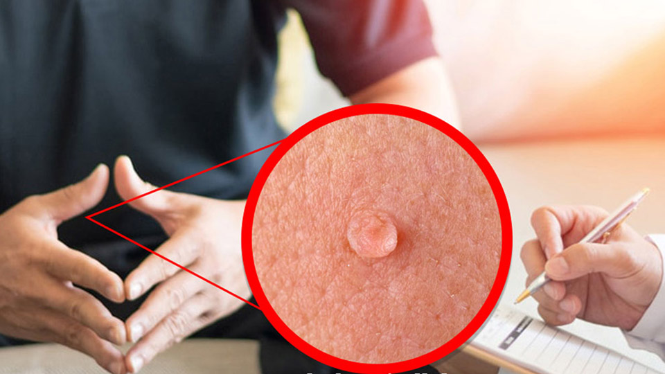 روش‌های انتقال زگیل تناسلی (HPV) را بشناسید! (قسمت دوم)
